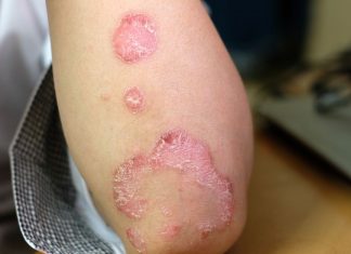 Boli frecvente si ciudate: psoriazisul si zona zoster