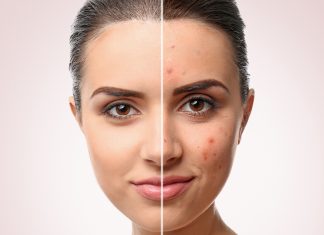 10 lucruri de incercat atunci cand acneea nu dispare