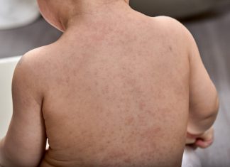 Ce este sindromul Gianotti-Crosti?